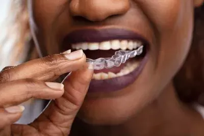 Invisalign